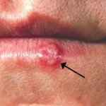 herpes simpleks na usni